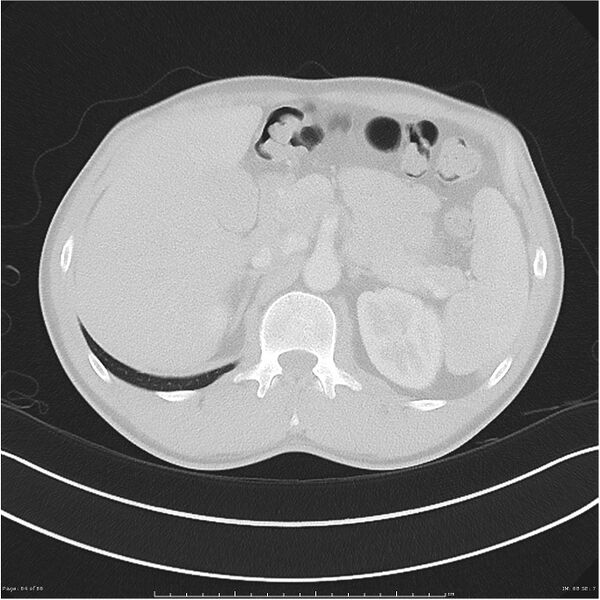 File:Cavitating lung cancer (Radiopaedia 25796-25945 Axial lung window 64).jpg
