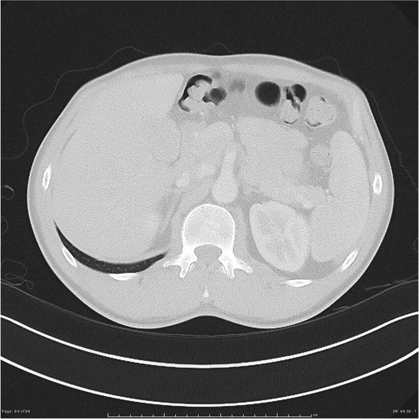 Cavitating lung cancer (Radiopaedia 25796-25945 Axial lung window 64).jpg