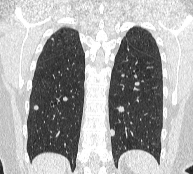 File:Cavitating pulmonary metastases (Radiopaedia 17796-17555 Coronal lung window 23).jpg