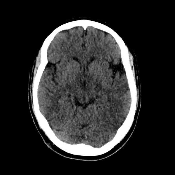 File:Central nervous system Langerhans cell histiocytosis (Radiopaedia 65728-74878 Axial non-contrast 24).jpg