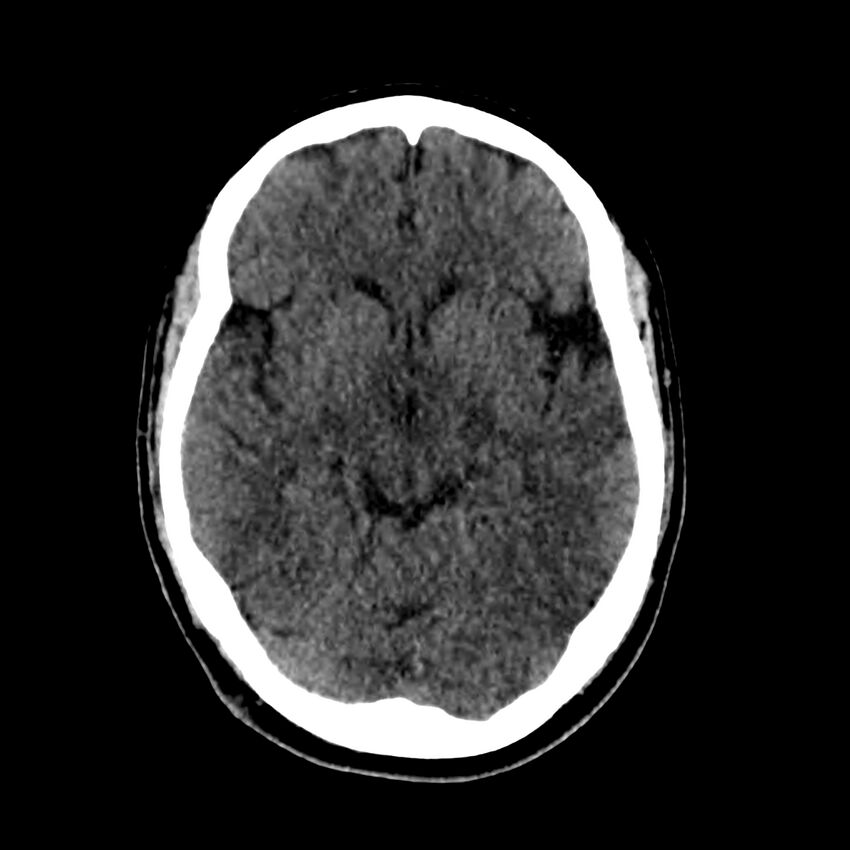 Central nervous system Langerhans cell histiocytosis (Radiopaedia 65728-74878 Axial non-contrast 24).jpg
