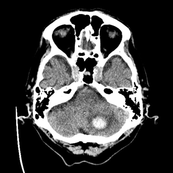 File:Cerebellar hemorrhage (Radiopaedia 27193-27359 Axial non-contrast 9).jpg