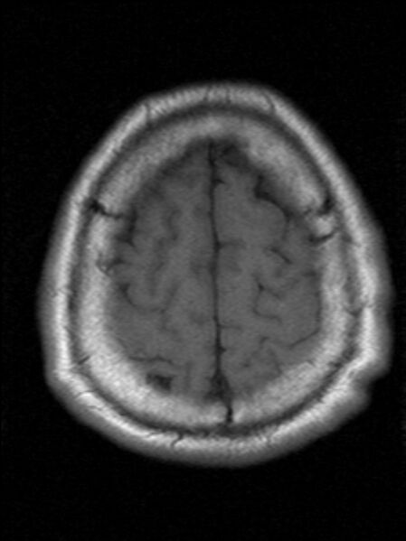 File:Cerebellopontine angle meningioma (Radiopaedia 24459-24764 Axial T1 21).jpg