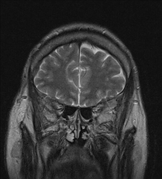 File:Cerebellopontine angle meningioma (Radiopaedia 24459-24764 Coronal T2 4).jpg