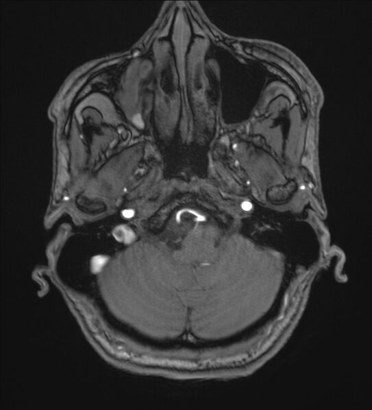 File:Cerebellopontine angle meningioma (Radiopaedia 72983-83680 Axial MRA 14).jpg