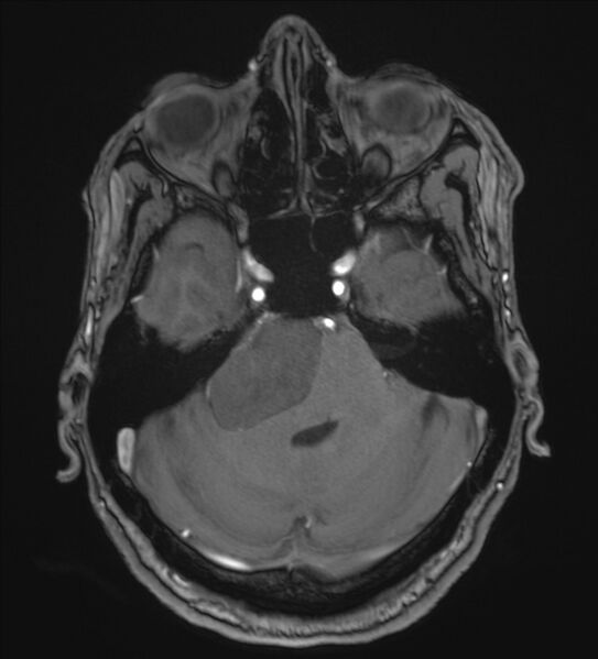 File:Cerebellopontine angle meningioma (Radiopaedia 72983-83680 Axial MRA 31).jpg