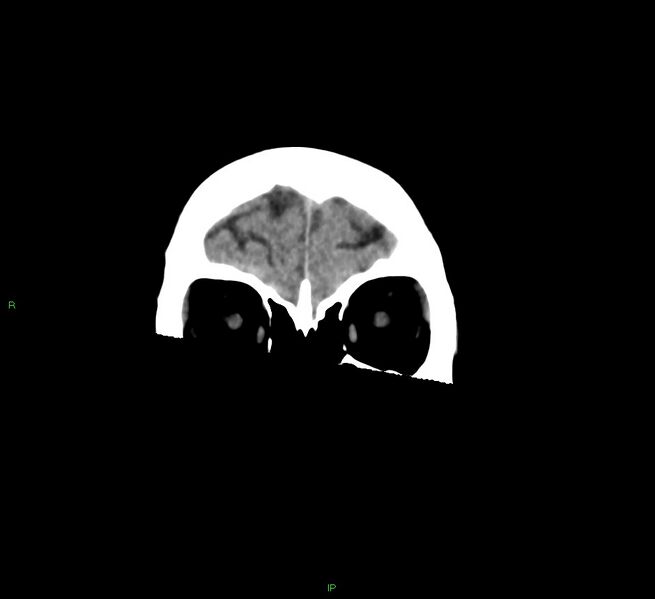 File:Cerebral amyloid angiopathy-associated lobar intracerebral hemorrhage (Radiopaedia 58378-65516 Coronal non-contrast 53).jpg