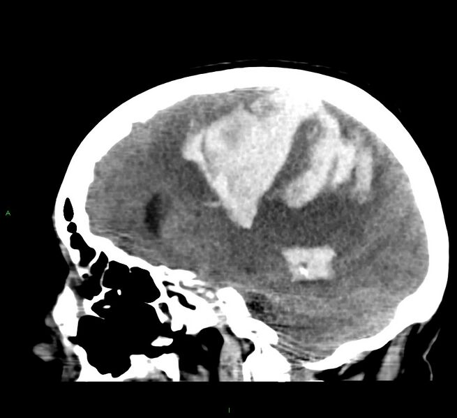File:Cerebral amyloid angiopathy-associated lobar intracerebral hemorrhage (Radiopaedia 58379-65519 C 23).jpg
