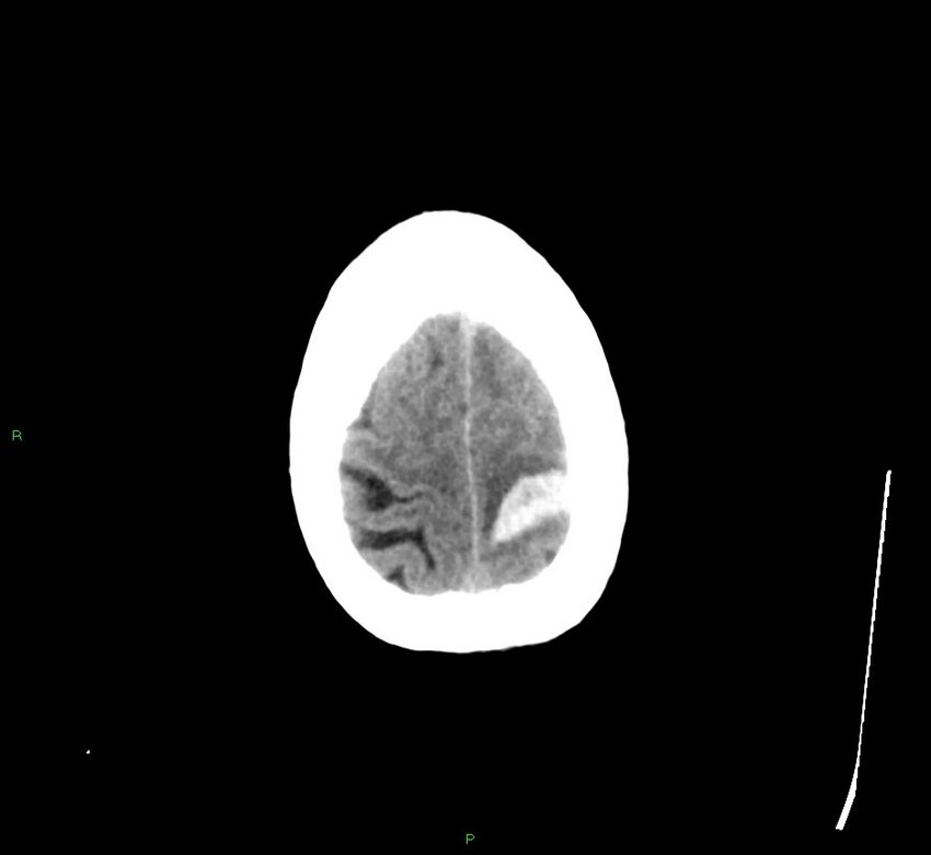 Cerebral amyloid angiopathy-associated lobar intracerebral hemorrhage (Radiopaedia 58529-65681 Axial non-contrast 7).jpg