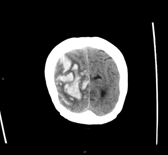 File:Cerebral amyloid angiopathy-associated lobar intracerebral hemorrhage (Radiopaedia 58563-65727 Coronal non-contrast 12).jpg