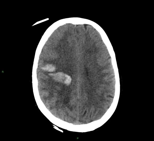 File:Cerebral amyloid angiopathy-associated lobar intracerebral hemorrhage (Radiopaedia 58566-65730 Axial non-contrast 19).jpg