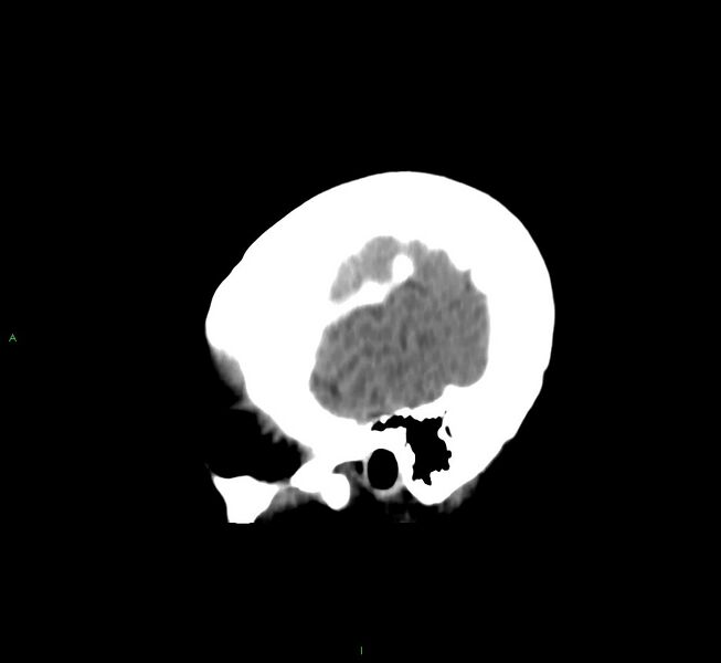 File:Cerebral amyloid angiopathy-associated lobar intracerebral hemorrhage (Radiopaedia 58566-65730 C 45).jpg
