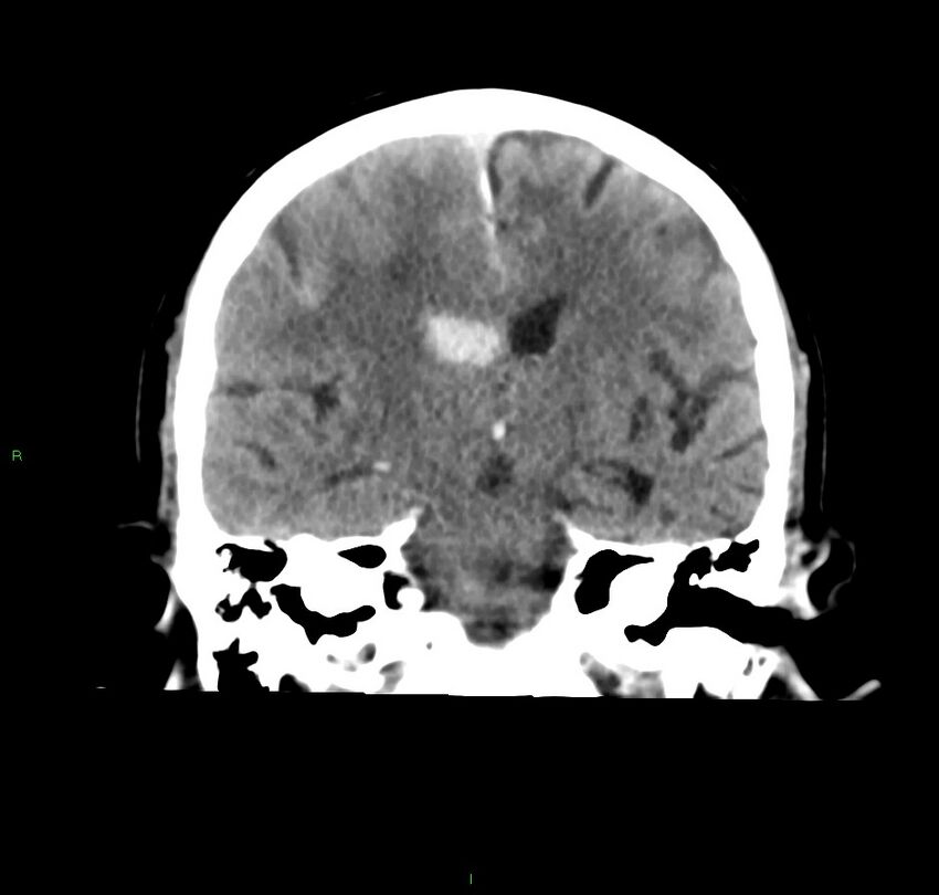 Cerebral amyloid angiopathy-associated lobar intracerebral hemorrhage (Radiopaedia 59356-66716 Coronal non-contrast 34).jpg