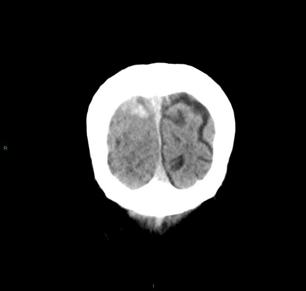 File:Cerebral amyloid angiopathy-associated lobar intracerebral hemorrhage (Radiopaedia 59356-66716 Coronal non-contrast 9).jpg