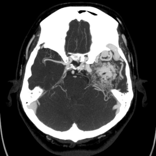 File:Cerebral arteriovenous malformation (Radiopaedia 43729-47189 B 16).jpg