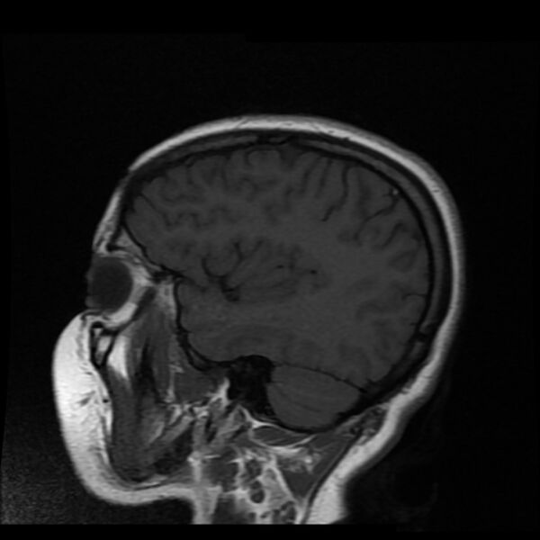 File:Cerebral cavernous malformation (Radiopaedia 44301-47942 Sagittal T1 4).jpg
