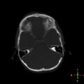Cerebral contusion (Radiopaedia 48869-53911 Axial bone window 16).jpg