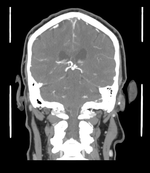 File:Cerebral dural venous sinus thrombosis (Radiopaedia 86514-102576 B 46).jpg