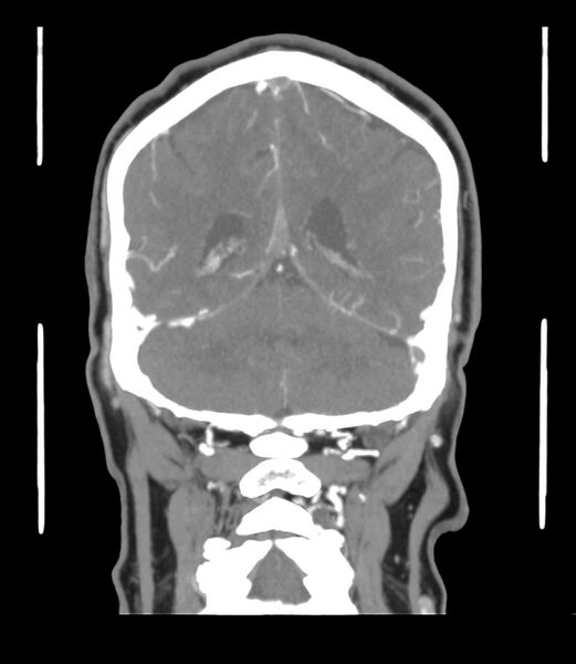 File:Cerebral dural venous sinus thrombosis (Radiopaedia 86514-102576 B 52).jpg