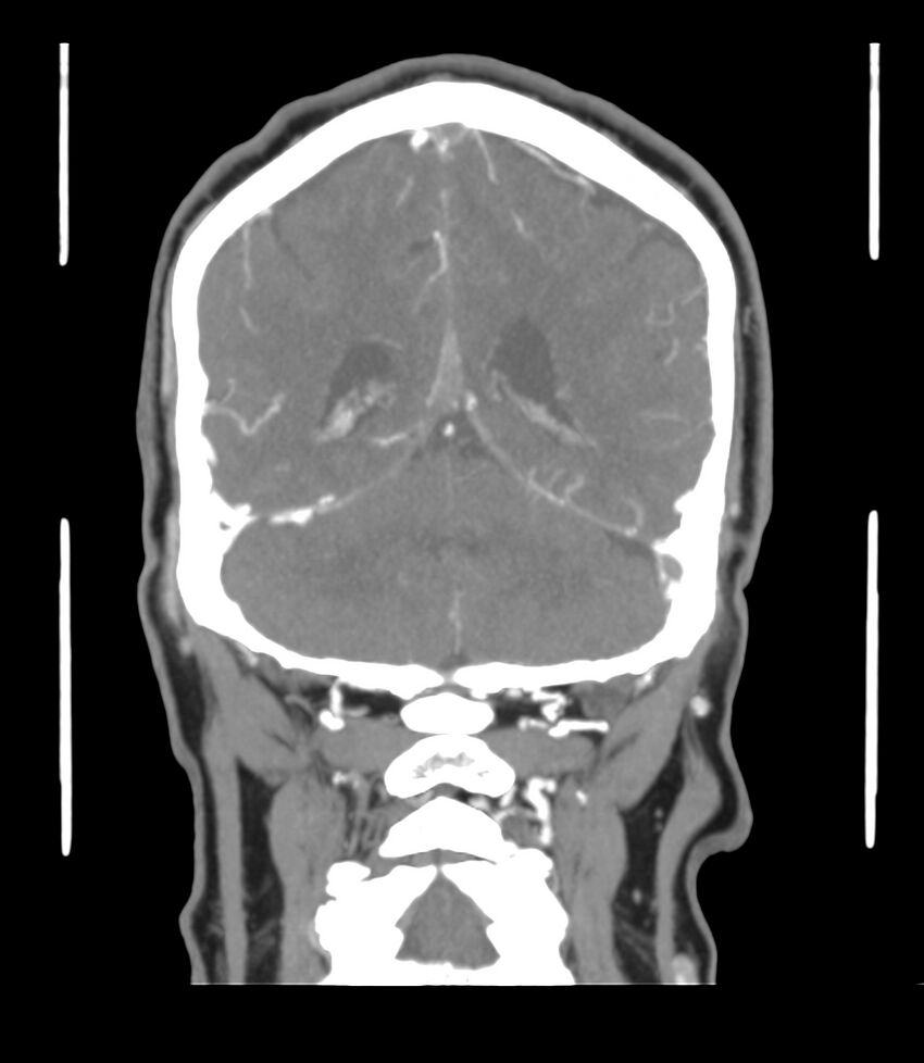 Cerebral dural venous sinus thrombosis (Radiopaedia 86514-102576 B 52).jpg