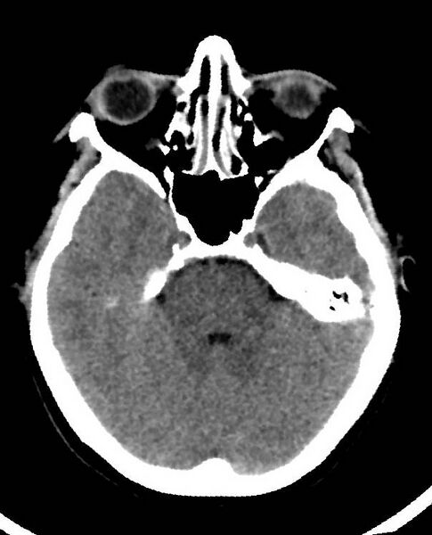 File:Cerebral edema due to severe hyponatremia (Radiopaedia 89826-106938 Axial non-contrast 33).jpg