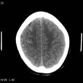 Cerebral hemorrhagic contusion with subdural and subarachnoid hemorrhage (Radiopaedia 10680-19197 Axial non-contrast 19).jpg
