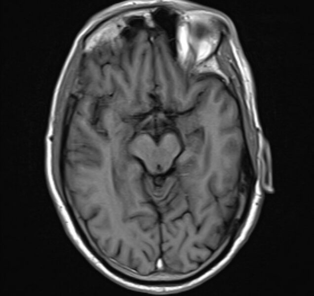 File:Cerebral venous thrombosis (Radiopaedia 71207-81504 Axial T1 11).jpg