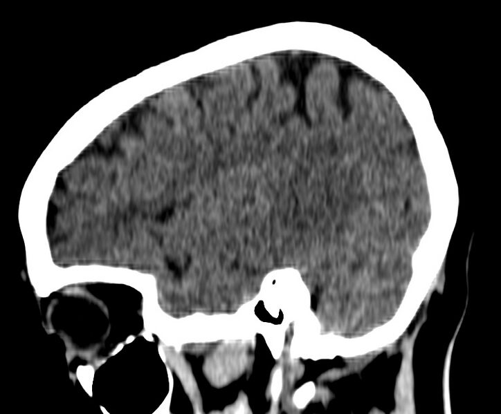 File:Cerebral venous thrombosis - CT only (Radiopaedia 41031-43778 B 7).jpg