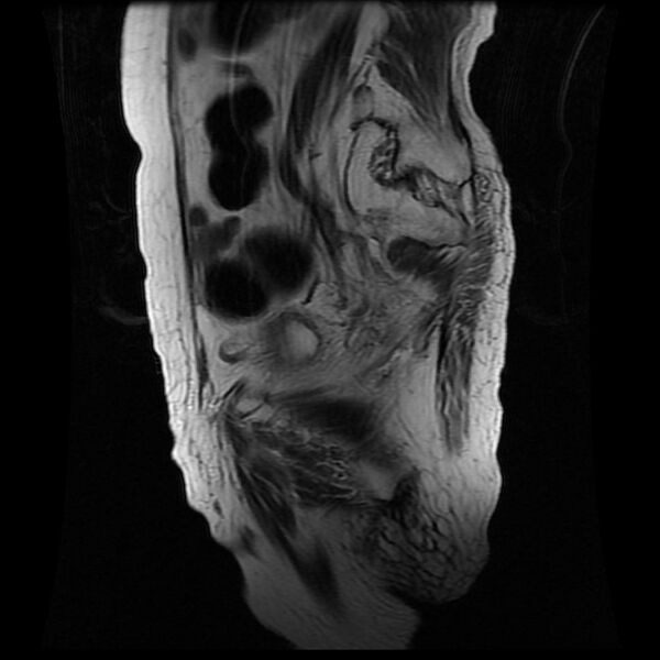 File:Cervical carcinoma (Radiopaedia 78847-91705 Sagittal T2 13).jpg