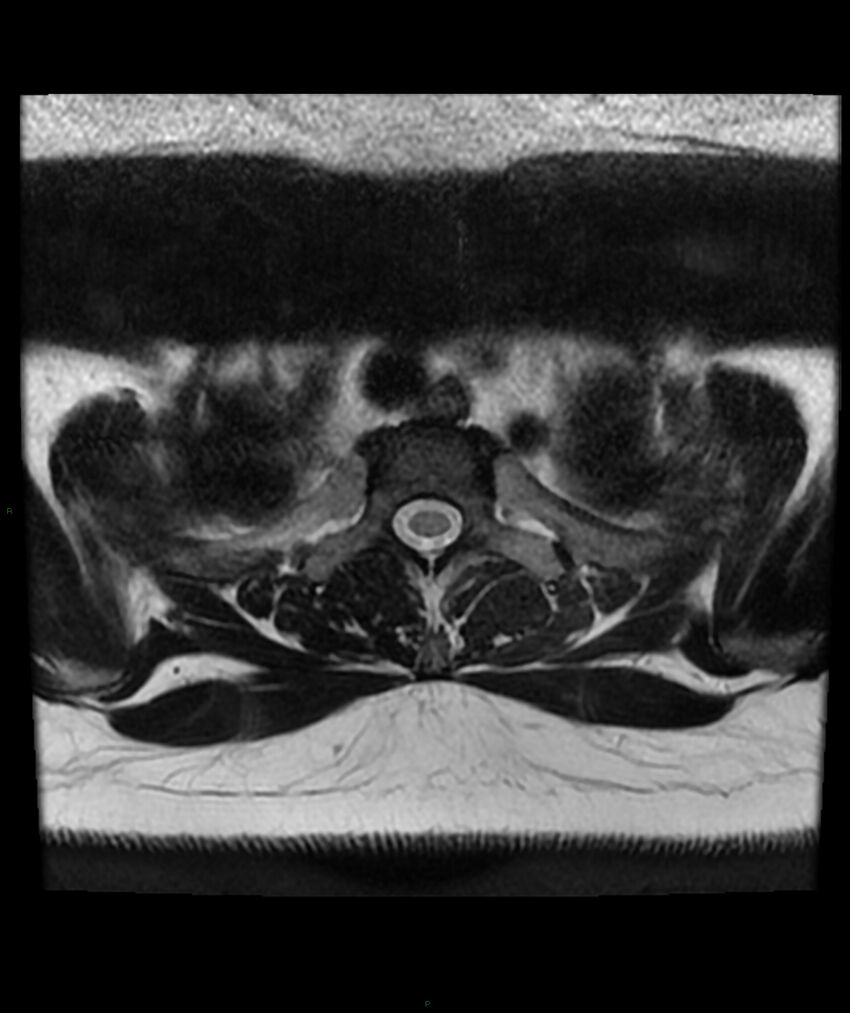 Cervical disc prolapse (Radiopaedia 80258-93598 Axial T2 96).jpg