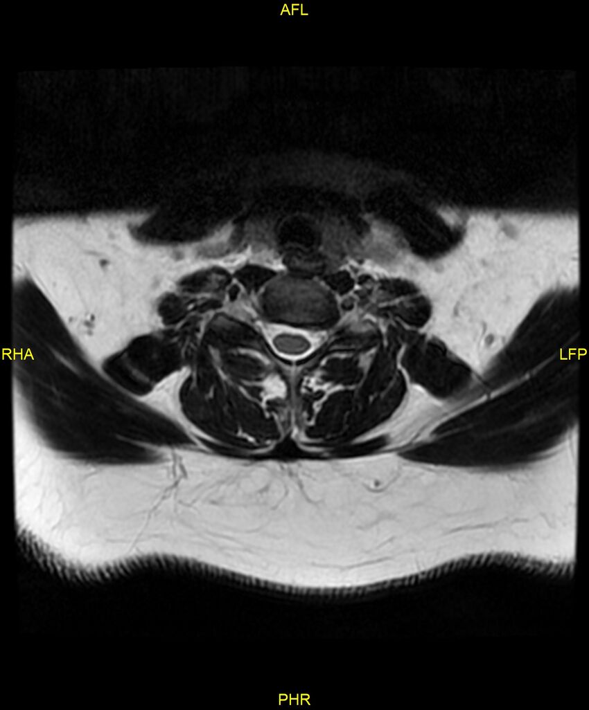 Cervical disc protrusion (Radiopaedia 87147-103415 Axial T2 49).jpg