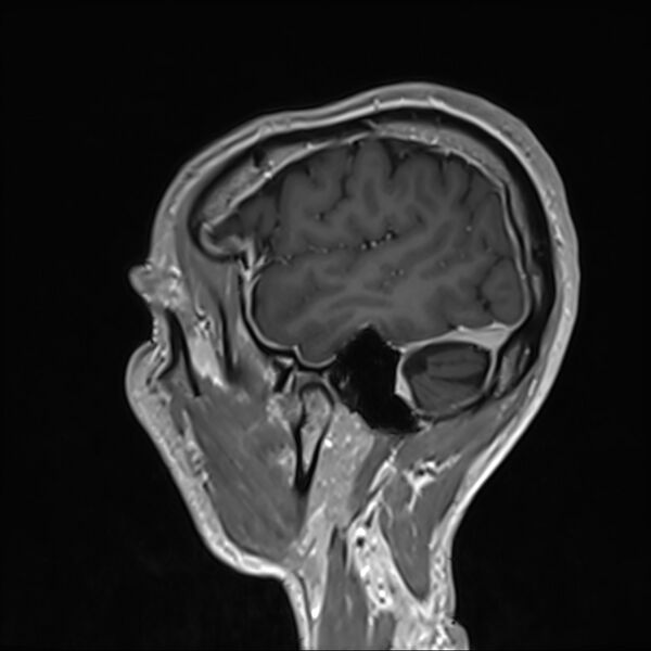 File:Cervical dural CSF leak on MRI and CT treated by blood patch (Radiopaedia 49748-54995 G 106).jpg