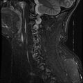 Cervical flexion teardrop fracture with cord hemorrhage (Radiopaedia 32497-33455 Sagittal STIR 14).jpg