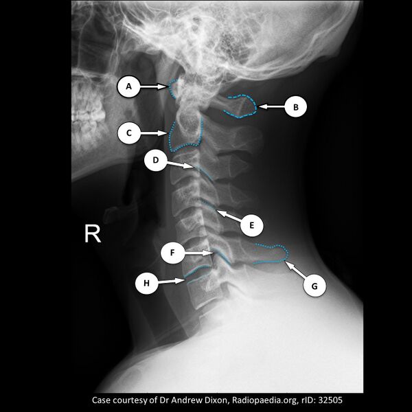 File:Cervical spine anatomy (Radiopaedia 58729-65951 A 1).jpg