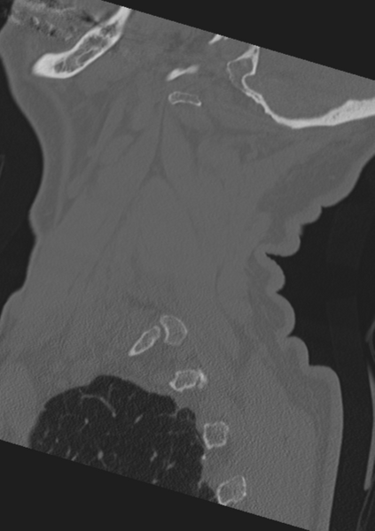 File:Cervical spine fractures with vertebral artery dissection (Radiopaedia 53296-59268 Sagittal bone window 8).png
