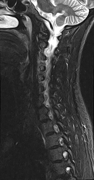 File:Cervical spondylodiscitis and calvarial hemangioma (Radiopaedia 64317-73104 Sagittal STIR 9).jpg
