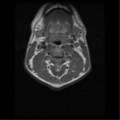 Cervical vertebrae metastasis (Radiopaedia 78814-91667 Axial T1 2).png