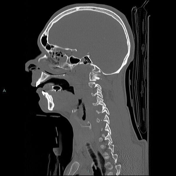 File:Cervical vertebral burst fracture (Radiopaedia 37420-39258 Sagittal bone window 24).jpg