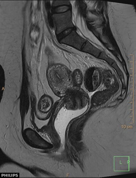 File:Cesarian scar endometriosis (Radiopaedia 68495-78066 Sagittal T2 15).jpg