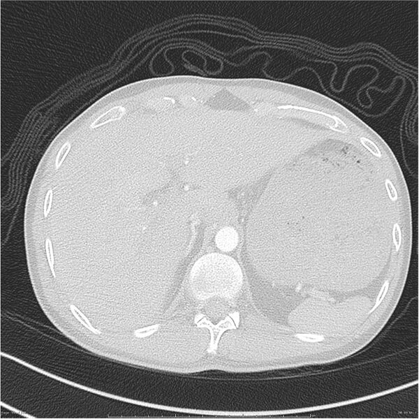 File:Chest and abdomen multi-trauma (Radiopaedia 26294-26425 lung window 99).jpg