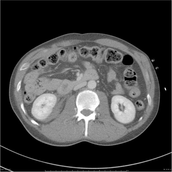 File:Chest and abdomen multi-trauma (Radiopaedia 26294-26426 bone window 39).jpg
