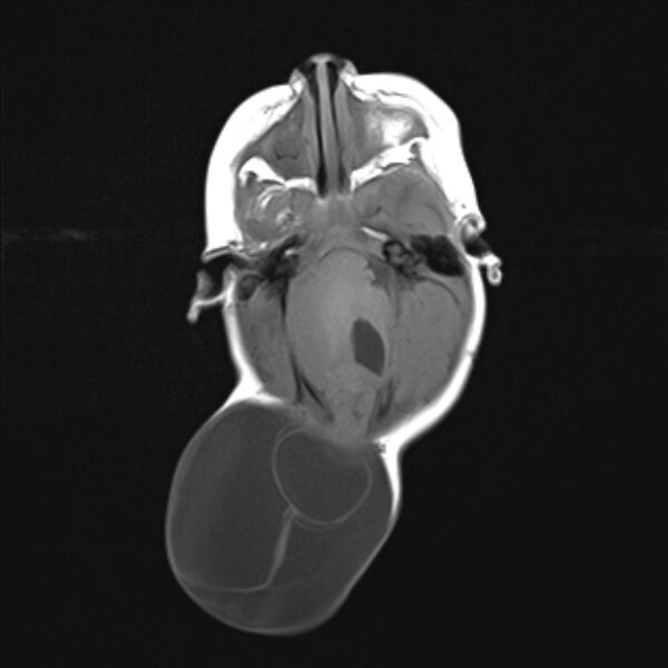 File:Chiari III malformation with occipital encephalocele (Radiopaedia 79446-92559 Axial T1 11).jpg
