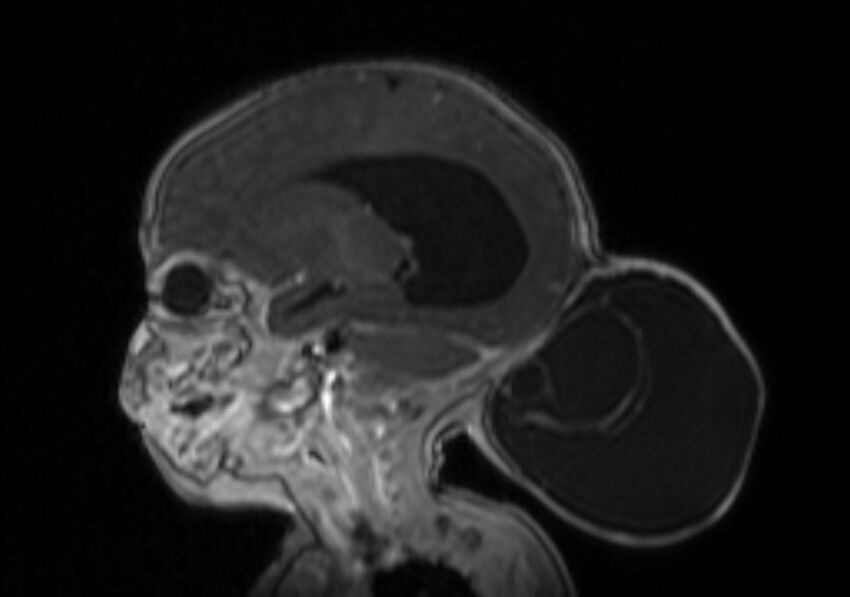 Chiari III malformation with occipital encephalocele (Radiopaedia 79446-92559 Sagittal T1 C+ mpr 28).jpg