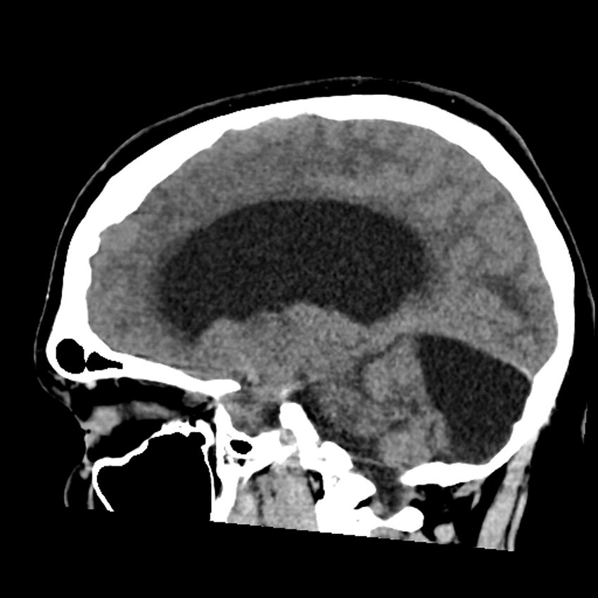 Chiasmatic-hypothalamic juvenile pilocytic astrocytoma (Radiopaedia 78533-91237 B 28).jpg