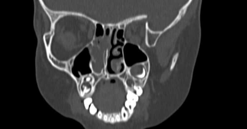 File:Choanal atresia (Radiopaedia 51295-56972 Coronal bone window 40).jpg