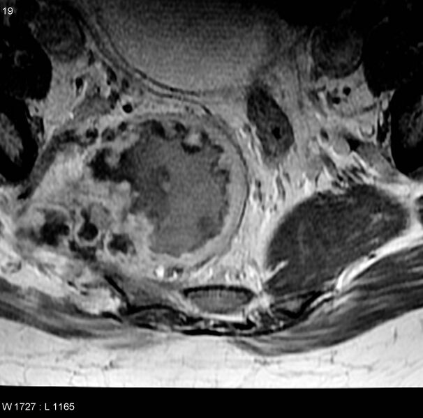 File:Chondrosarcoma - sacrum (Radiopaedia 6173-7627 Axial T1 C+ 6).jpg