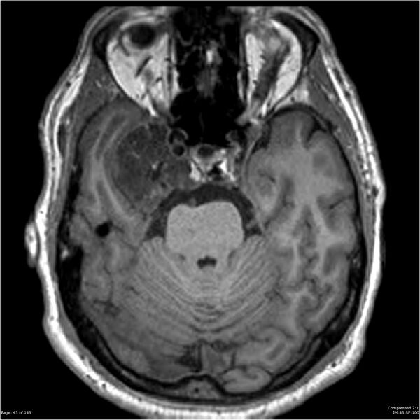 File:Chondrosarcoma of skull base- grade II (Radiopaedia 40948-43654 Axial T1 43).jpg