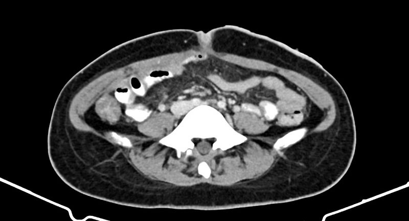 File:Choriocarcinoma liver metastases (Radiopaedia 74768-85766 A 133).jpg