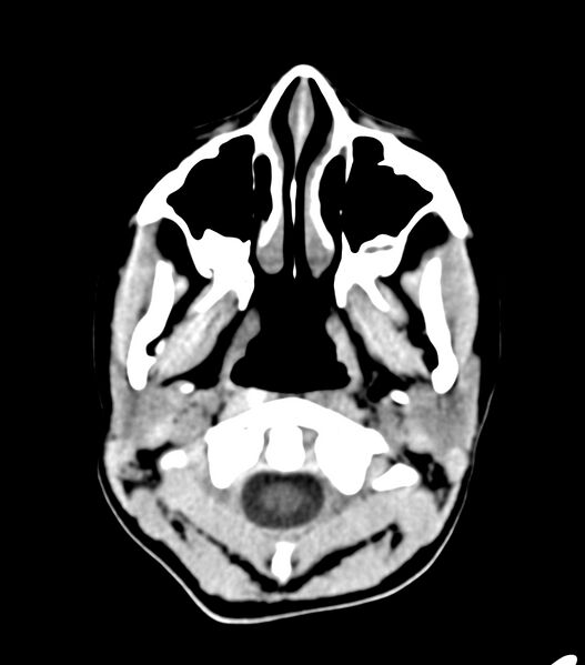 File:Choroid plexus carcinoma (Radiopaedia 91013-108552 Axial non-contrast 2).jpg
