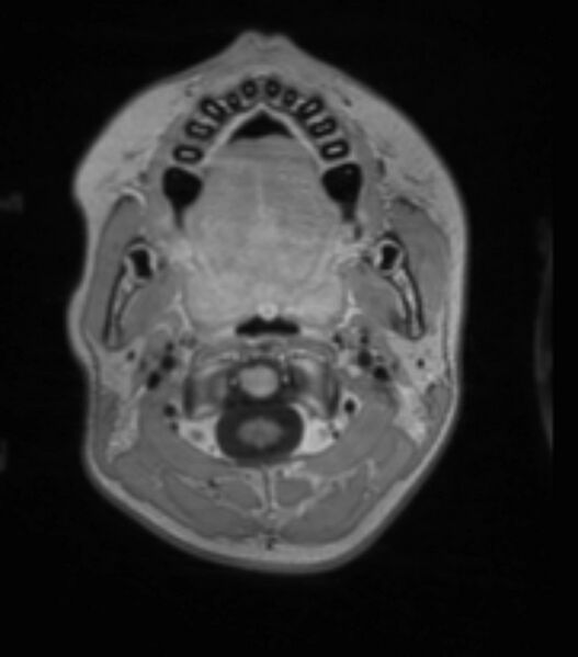 File:Choroid plexus carcinoma (Radiopaedia 91013-108553 Axial T1 C+ 51).jpg